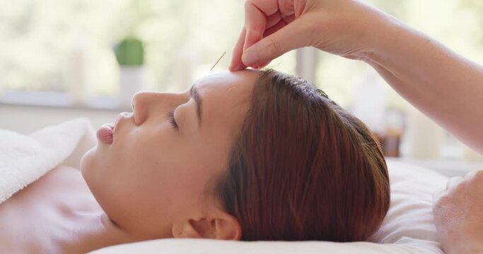 Beautician or masseuse placing acupuncture needles into forehead of female client. Closeup of a woman having anti aging dry needling done to her face. Young woman lying on a beauty spa massage table