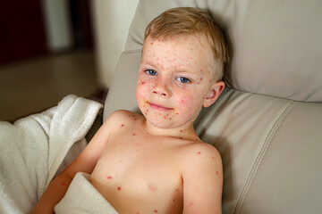 Natural vaccination. Contagious disease.