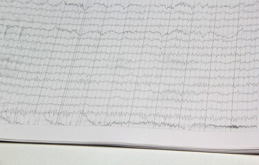 Results of an electroencephalogram after a neurophysiological examination, which is the recording...