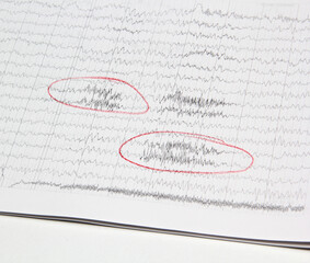 Results of an electroencephalogram after a neurophysiological examination, which is the recording...