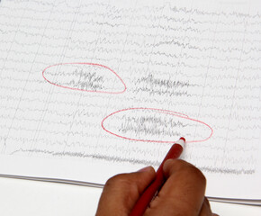 Results of an electroencephalogram after a neurophysiological examination, which is the recording...