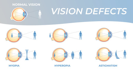 Vision defects and their correction with intraocular lenses. Vision problems with hyperopia, myopia and astigmatism. Section of an eye for ophthalmologist infographics - obrazy, fototapety, plakaty