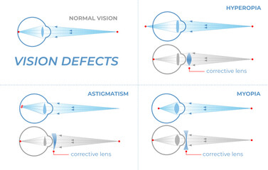 Vision defects and their correction with intraocular lenses. Vision problems with hyperopia, myopia and astigmatism. Section of an eye for ophthalmologist infographics
