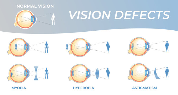 Vision defects and their correction with intraocular lenses. Vision problems with hyperopia, myopia and astigmatism. Section of an eye for ophthalmologist infographics