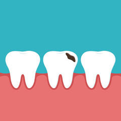 Vector dental medical illustration of a healthy tooth and a tooth with decay and a gum hole.