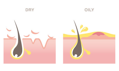 Skin cross section of pore types. Acne on oily skin, wrinkles on dry skin. Pale colored illustration in flat cartoon style.