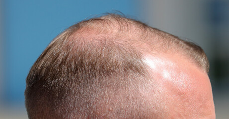 Bald patch on a man's head