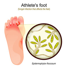 Athlete's foot. fungal infection that affects the feet. - obrazy, fototapety, plakaty