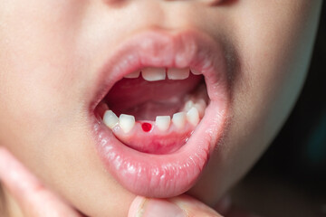The girl opened her mouth to check for the blood caused by the loose baby teeth. oral and dental care concept