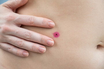 Close-up of a removed wart on a woman's abdomen. Human papillomavirus after burning.