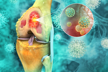 Bone cancer, knee joint, giant cell tumor of bone, osteosarcoma, 3d illustration - obrazy, fototapety, plakaty