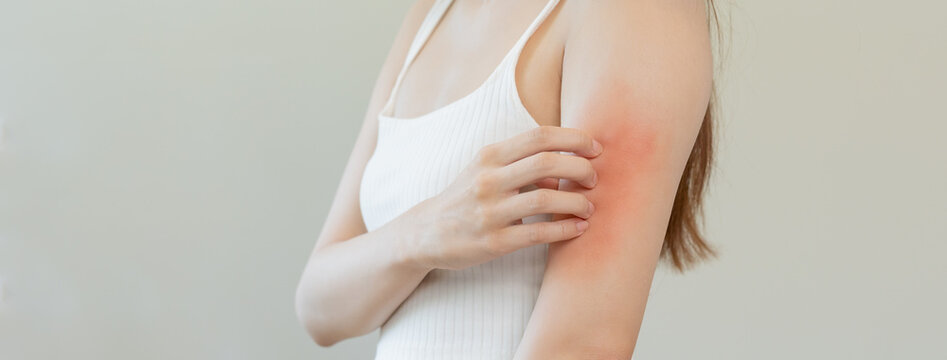 Dermatology, asian young woman, girl allergy, allergic reaction from atopic, insect bites on her arm, hand in scratching itchy, itch red spot or rash of skin. Healthcare, treatment of beauty.