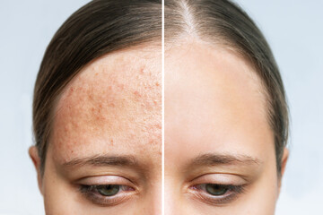 Cropped shot of a young woman's face before and after acne treatment. Pimples, allergic red rash on...