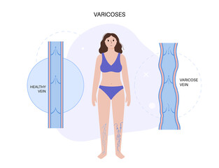 Varicose veins treatment