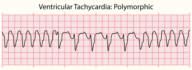ECG line: Ventricular Tachycardia Polymorphic in 6 second ECG paper line - obrazy, fototapety, plakaty
