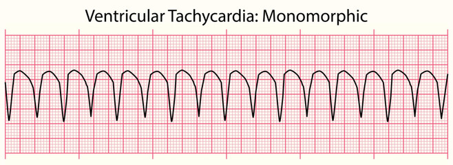 ECG line: Ventricular Tachycardia Monomorphic in 6 second ECG paper line