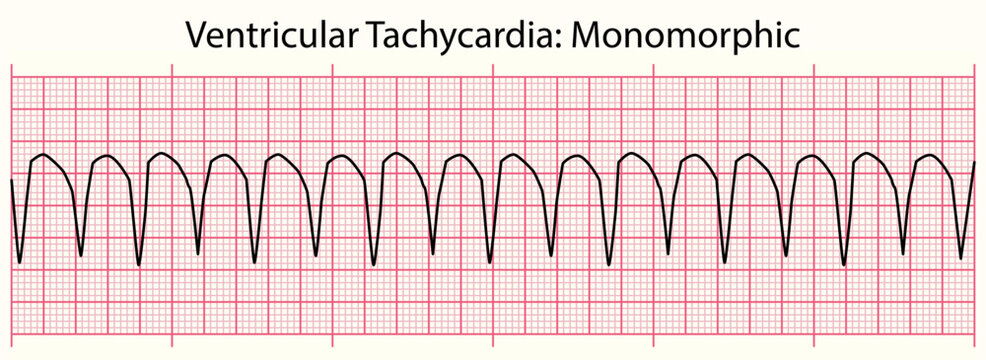 ECG line: Ventricular Tachycardia Monomorphic in 6 second ECG paper line
