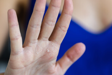 Woman shows problem with dry skin on the hand. Closeup. Selective focus. 