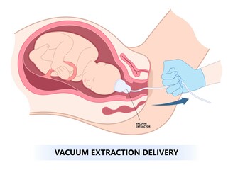 Vacuum assisted delivery the procedure in medical labor to pull baby from uterus fetal c section scalp edema occiput anterior pain facial palsy skull fracture