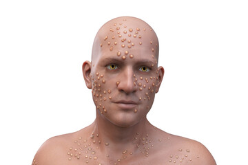 A man with smallpox disease