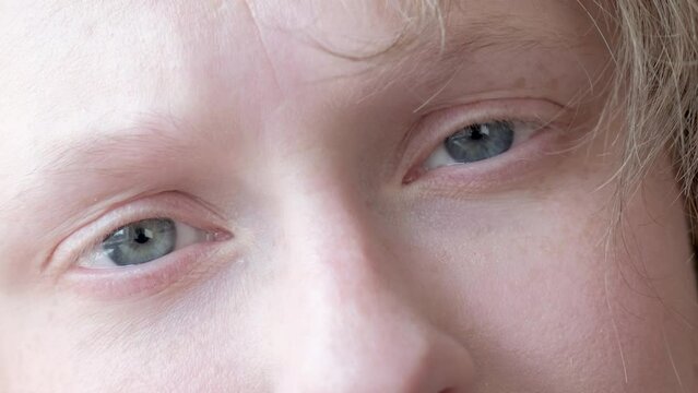 woman with nystagmus, uncontrolled rhythmic movements of the eyeballs, Pathological nystagmus
