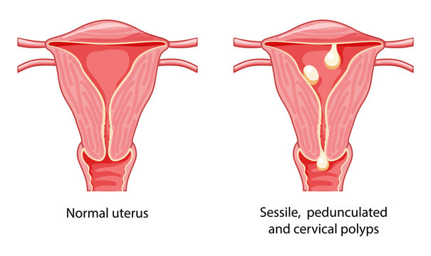 Set of Polyps in the uterus Female reproductive system in cross sections diseases and normal. Front view in a cut. Human anatomy internal organs location scheme, cervix, ovary flat style icon
