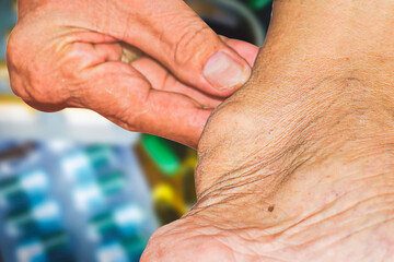 Severe gout in men suffering from joint pain, bone pain, gout, rheumatoid symptoms, radioactive...