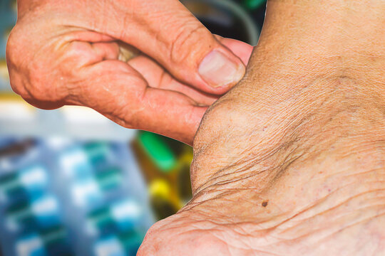 Severe gout in men suffering from joint pain, bone pain, gout, rheumatoid symptoms, radioactive sickness, ill man concept of male osteoporosis, injured bone, injury, pain, arthritis,arm, foot, knee