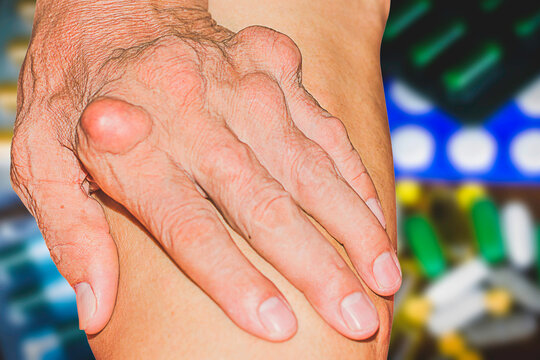 Severe gout in men suffering from joint pain, bone pain, gout, rheumatoid symptoms, radioactive sickness, ill man concept of male osteoporosis, injured bone, injury, pain, arthritis,arm, foot, knee