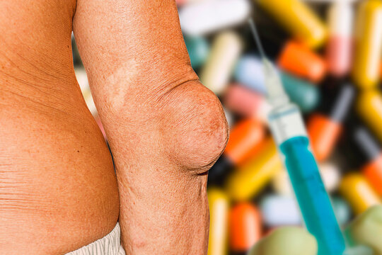 Severe gout in men suffering from joint pain, bone pain, gout, rheumatoid symptoms, radioactive sickness, ill man concept of male osteoporosis, injured bone, injury, pain, arthritis,arm, foot, knee