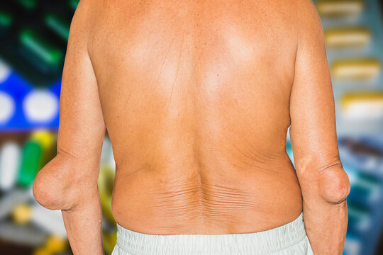 Severe gout in men suffering from joint pain, bone pain, gout, rheumatoid symptoms, radioactive sickness, ill man concept of male osteoporosis, injured bone, injury, pain, arthritis,arm, foot, knee