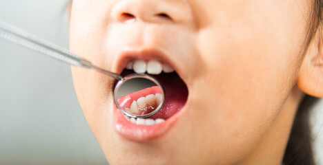 Dental kid health examination. Doctor examines oral cavity of little child uses mouth mirror to...