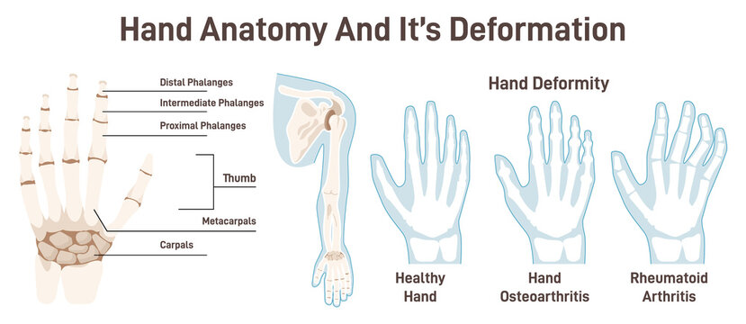 Human hand bones and its deformations. Anatomical structure