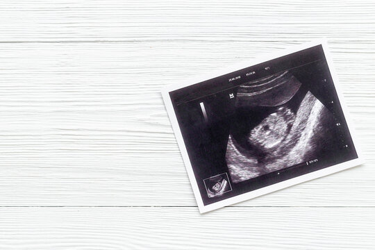 Prenatal ultrasound screening of unborn baby. Pregnancy background