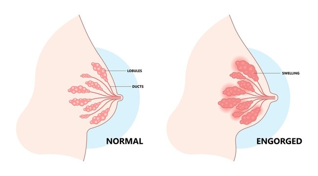 Anatomy Of Breast Cancer Engorged Blocked Mass Milk Ducts Swollen Breastfeed