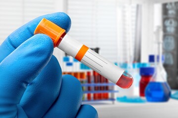 Researcher holding blood test tube infected with monkey pox virus. Doctor with a blood sample in a...