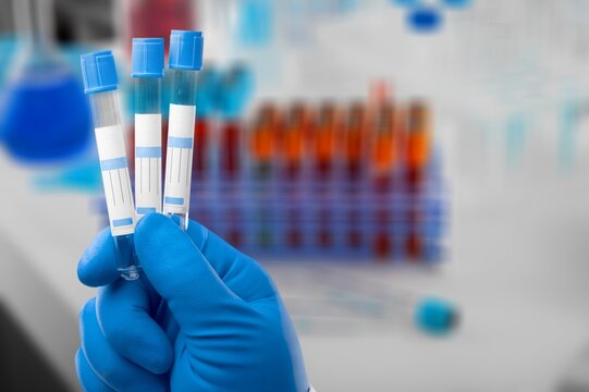Blood sample of patient for complete screening test in laboratory. doctor with Blood tube and catheter