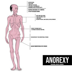 anorexia, an eating disorder that causes people to lose more weight than is considered healthy for their age and height. - obrazy, fototapety, plakaty