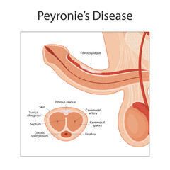 Peyronie disease. male reproductive system. penis medical vector illustration. - obrazy, fototapety, plakaty