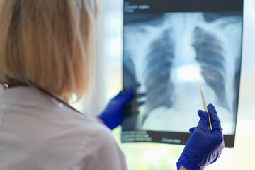 Female doctor pulmonologist holding x-ray photograph of lungs in hands - obrazy, fototapety, plakaty