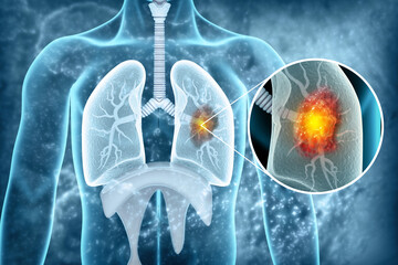 Lung Cancer or lung  tumor disease.3d illustration
