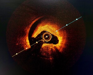Intravascular imaging Optical Coherence Tomography (OCT) shown dissection in coronary artery.	