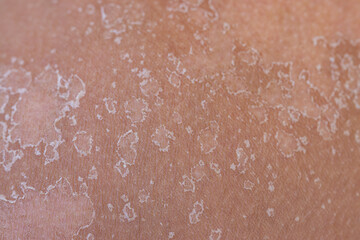 peeling of the skin after a sunburn as a background