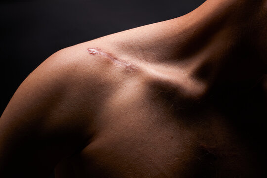 Large scar on  male shoulder after surgery operation isolated on black background.