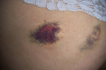 Close up of a hematoma on buttock after fall. A minor injury after sport activity appearing as a...