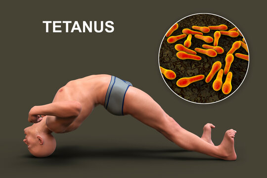 Opisthotonus in a man suffering from tetanus,