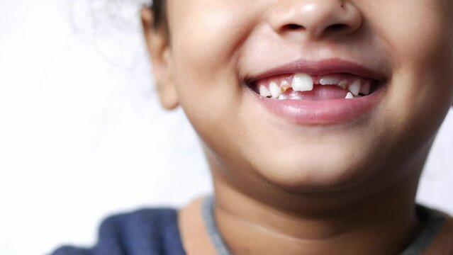 child girl with deformed teeth 