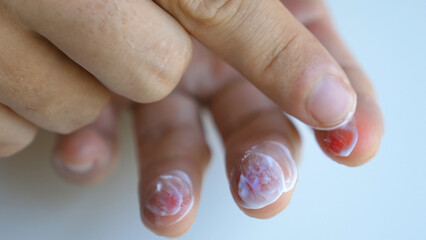 Man smears scratched skin cuts wound on hand by healing cream. Male arm apply ointment by finger on...