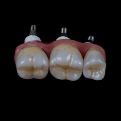 press ceramic crowns and veneers
