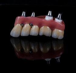 press ceramic crowns and veneers